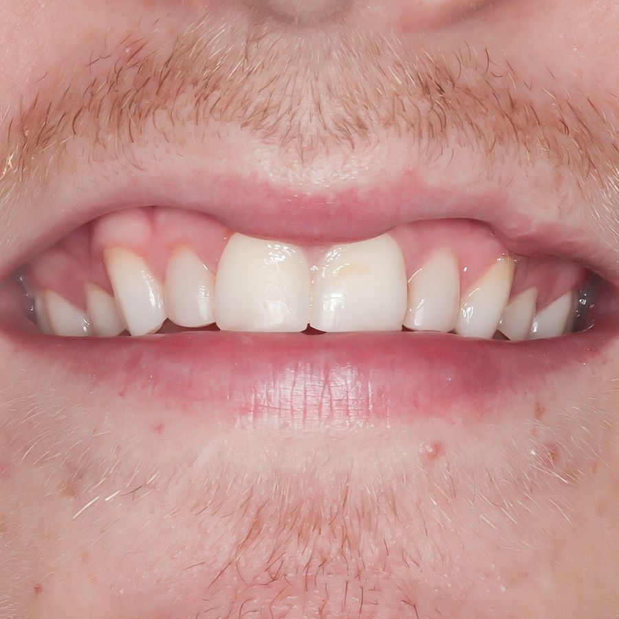 porcelain veneers - before - 3dental